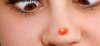 5-Simple-Ways-To-Remove-Pimples-On-The-Nose.jpg