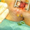 Preoperative-image-of-recurrent-perianal-fistula-note-two-external-openings_Q320.jpg